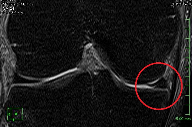 前十字靭帯 損傷,半月板 損傷,やんごとなきくらげ